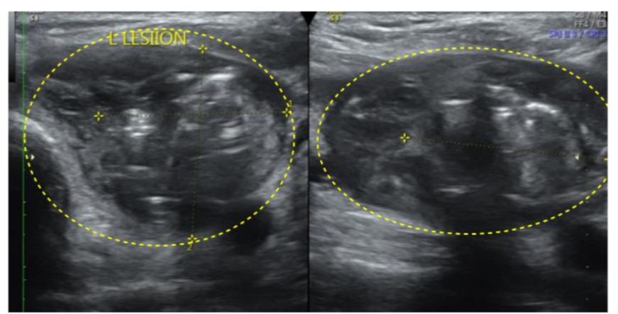 A large heterogenous hypoechoic complex avascular cystic lesion(2.0x1.5x1.3cm) with thick septations and multiple air pockets with no internal vascularity in the left lobe of the thyroid.