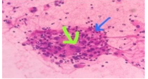 Scant cellular consisting of atypical cells with hyperchromatic nuclei and some with prominent nucleoli and a moderate amount of cytoplasm. Bethesda category 6.