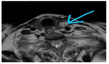 Well-defined solid nodule in the left lobe of the thyroid.