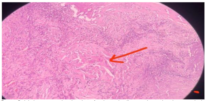 Lobules, nest, and trabeculae of polygonal cells, vesicular nuclei, distinct nucleoli, stippled chromatin, and abundant cytoplasm with areas of necrosis. (low power field).