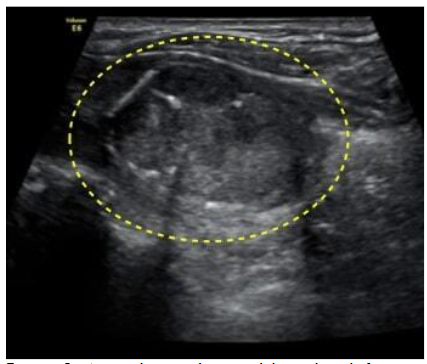 An iso-hyperechoic nodule with calcification (2.8 x1.9cm) in the left lobe of the thyroid.