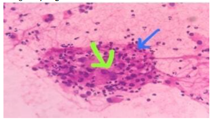 Scant cellular consisting of atypical cells with hyperchromatic nuclei and some with prominent nucleoli and a moderate amount of cytoplasm. Bethesda category 6.