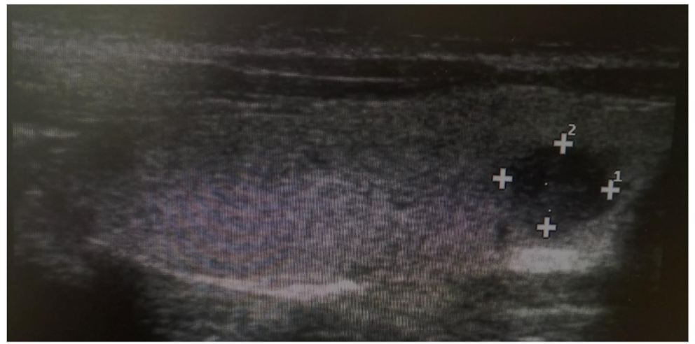 Figure 2. A Sample of Sagittal View of Thyroid Sonogram for A 22 years, Female Participant Demonstrating a Solitary Solid Nodule.