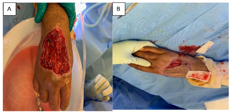 Wound Size Difference (sq. cm) Upon Treatment with First Esterified Hyaluronic Acid Matrix (eHAM).
