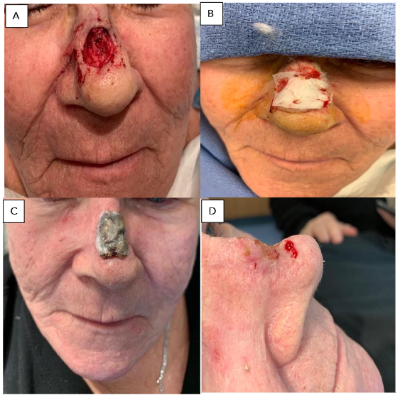 Recurrent basal cell carcinoma of nasal dorsum.