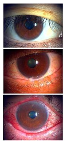 Figure 5. Zone A evaluation for lid margin grading. Left (grade 0): Healthy avascular region without lid margin vessels or hyperemia. Right (grade 4): Prominent diffuse hyperemia and fine vascular invasion of normally an avascular region. Such findings may represent chronic irritation of the ocular surface by intrinsic tear abnormalities or chronic exposure to external noxious eye drops.