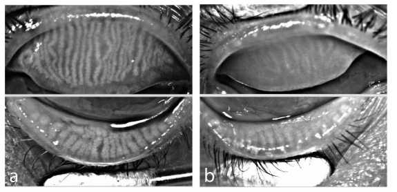 Figure 2. Meibomian gland morphology in oGVHD. Left (grade 0): Normal lid margin with minimal redness and visible orifices. Right (grade 4): Severe lid margin inflammation with gland obstruction and vascular engorgement.