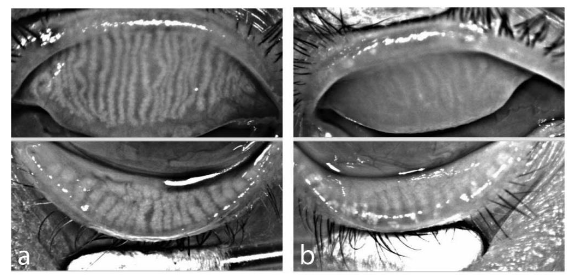 Figure 4. Infrared meibography of meibomian gland structure before and after hematopoietic stem cell transplantation. (a) Normal gland distribution in the left eye of a 58-year-old female before transplantation. (b) Extensive gland dropout in the right eye of a 52-year-old male after transplantation.