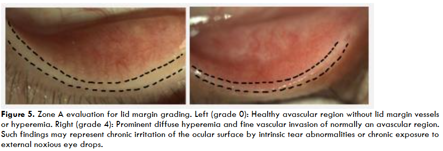 Figure 5. Validated Bulbar Redness (VBR 10)/ Bulbar Conjunctiva Redness scale used to quantify conjunctival injection severity in oGVHD and other ocular surface diseases. Redness scores range from 10 to 100 in increments of 10, based on visual grading of bulbar hyperemia.