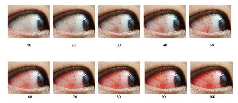 Figure 7. Simplified clinical grading scale for conjunctival injection in oGVHD and other inflammatory eye conditions. Grades 0–2 indicate absent, mild, or moderate to severe redness, based on vessel dilation and hyperemia.