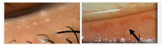 OSDI = (sum of all answered scores) × 25 ÷ number of questions answered.