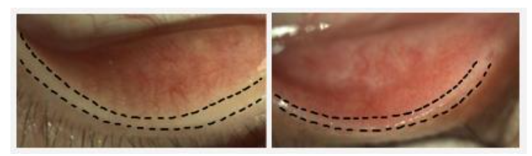Figure 6. Zone A evaluation for lid margin grading. Left (grade 0): Healthy avascular region without lid margin vessels or hyperemia. Right (grade 4): Prominent diffuse hyperemia and fine vascular invasion of normally an avascular region. Such findings may represent chronic irritation of the ocular surface by intrinsic tear abnormalities or chronic exposure to external noxious eye drops.