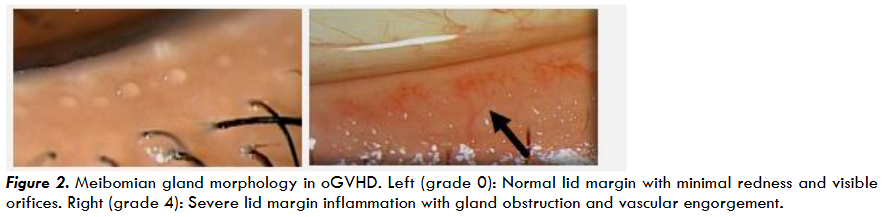Figure 2. Meibomian gland morphology in oGVHD. Left (grade 0): Normal lid margin with minimal redness and visible orifices. Right (grade 4): Severe lid margin inflammation with gland obstruction and vascular engorgement.