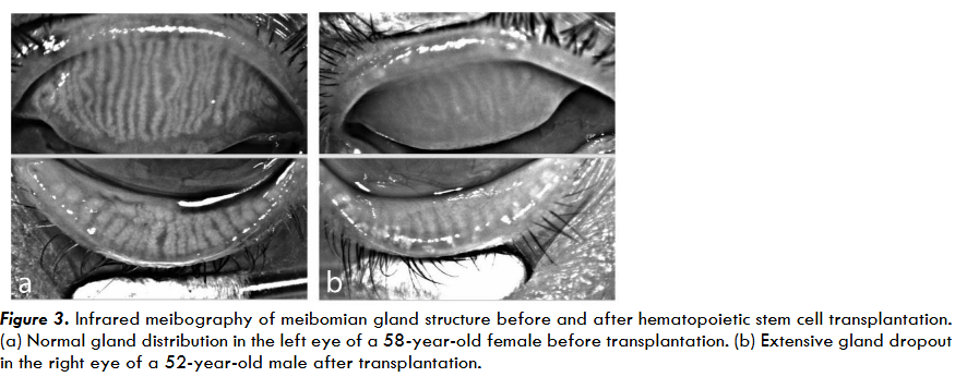 Figure 3. Infrared meibography of meibomian gland structure before and after hematopoietic stem cell transplantation. (a) Normal gland distribution in the left eye of a 58-year-old female before transplantation. (b) Extensive gland dropout in the right eye of a 52-year-old male after transplantation.