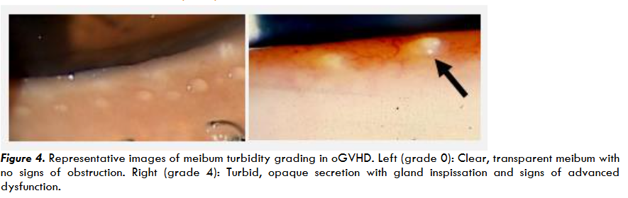 Figure 4. Simplified clinical grading scale for conjunctival injection in oGVHD and other inflammatory eye conditions. Grades 0–2 indicate absent, mild, or moderate to severe redness, based on vessel dilation and hyperemia.
