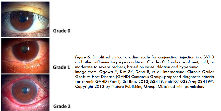 Figure 6. Grading scale for corneal fluorescein staining in oGVHD. Fluorescein dye highlights damaged epithelial areas under cobalt blue light. Grades range from 0 to 3 based on the extent and density of punctate epithelial erosions.