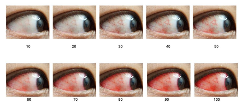 Figure 8. Validated Bulbar Redness (VBR 10)/ Bulbar Conjunctiva Redness scale used to quantify conjunctival injection severity in oGVHD and other ocular surface diseases. Redness scores range from 10 to 100 in increments of 10, based on visual grading of bulbar hyperemia.