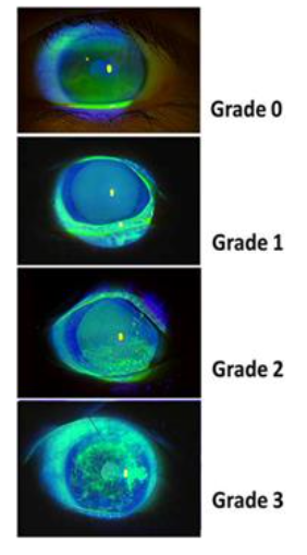Figure 9. Grading scale for corneal fluorescein staining in oGVHD. Fluorescein dye highlights damaged epithelial areas under cobalt blue light. Grades range from 0 to 3 based on the extent and density of punctate epithelial erosions.