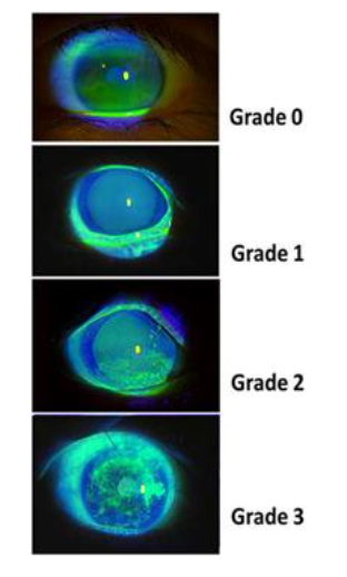 Figure 9. Grading scale for corneal fluorescein staining in oGVHD. Fluorescein dye highlights damaged epithelial areas under cobalt blue light. Grades range from 0 to 3 based on the extent and density of punctate epithelial erosions.