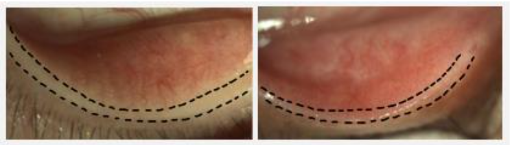 Figure 4. Representative images of meibum turbidity grading in oGVHD. Left (grade 0): Clear, transparent meibum with no signs of obstruction. Right (grade 4): Turbid, opaque secretion with gland inspissation and signs of advanced dysfunction.