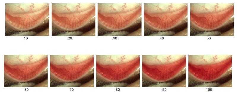 Figure 7. Validated Bulbar Redness (VBR 10)/ Bulbar Conjunctiva Redness scale used to quantify conjunctival injection severity in oGVHD and other ocular surface diseases. Redness scores range from 10 to 100 in increments of 10, based on visual grading of bulbar hyperemia.