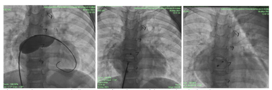 Cardiac angiogram balloon size confirms the size of the ASD then deployed 24 mm size ASO.