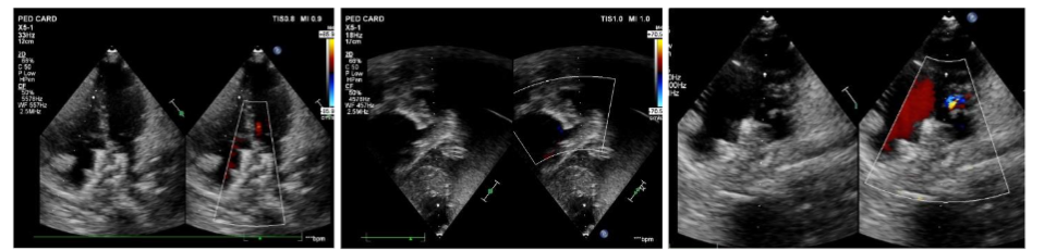 Echo showed ASD device in situ with no residual flow with secure position.
