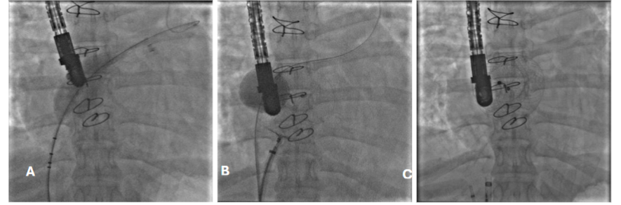 Cardiac angiogram(A,B,C) ASD size confirmed by the sizing balloon and deployed with balloon assistant.