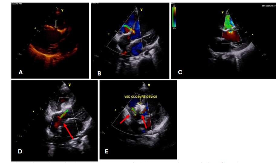 Echocardiography showed(A,B,C) two residual shunt, one at lower end of patch another at upper end near aortic leaflet.(D)Aortic regurgitation.(E)Closed one residual shunt with ADO I and another one near aortic leaflet left alone.