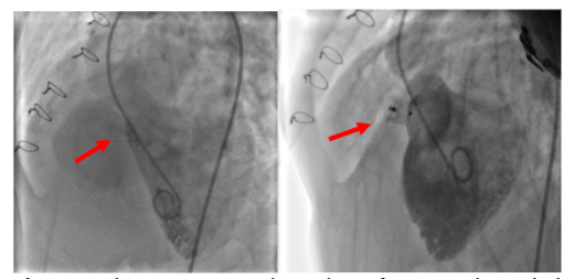 Cardiac angiogram showed significant L-R shunt which was closed by ADOI(10X8) device.