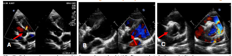 Echocardiography(A,B) showed residual VSD flow with L-R shunt &(C) device in situ with good position with no residual flow.