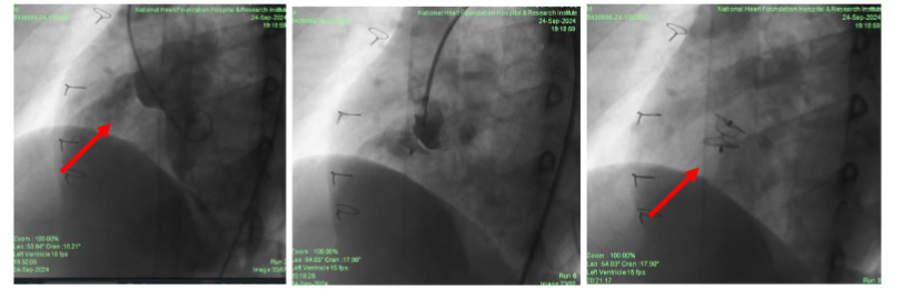 Cardiac angiogram showed VSD flow with L-R shunt which was closed by MFO(12X10 mm) device.