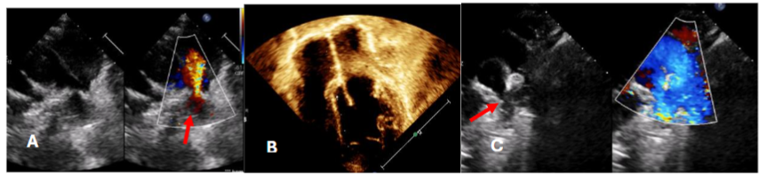 Echocardiography (A,B) showed residual PDA flow with L-R shunt with dilated LA, LV. & (C) PDA device in situ with good position with no residual flow.