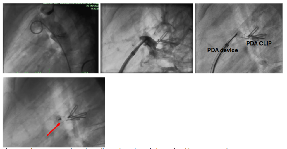 Cardiac angiogram showed PDA flow with L-R shunt which was closed by ADOI(8X6) device.