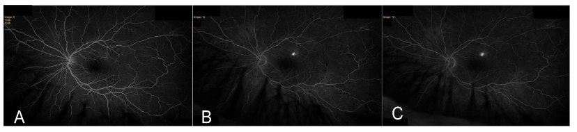 Sequences from A to E demonstrate a hyperfluorescent expansile dot in superotemporal macula consistent with CSCR.