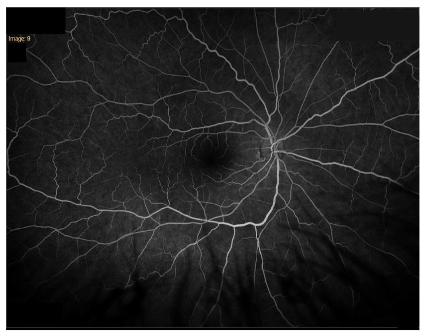 Fluorescein angiography of the right eye with normal vascular pattern.