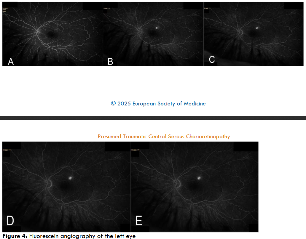Traumatic Central Serous Chorioretinopathy Case Report - European ...