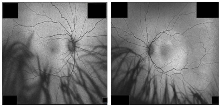Left image: normal FAF pattern in the right eye. Right image: mild diffuse hyperautofluorescence in posterior pole consistent with residual mild SRF in the left eye.