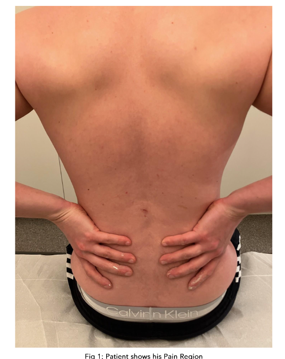 Fig 1: Patient's back showing injection sites.
