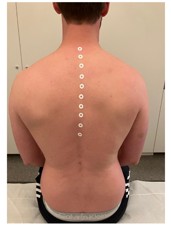 Fig 2: Ten SC Injections were applied on the Midline Fascia in the Origin Region.