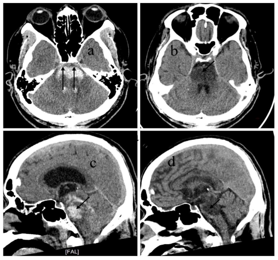 Figure 2: CT images from Case demonstrate complete ventral pons involvement: Figure 2a, 2c: Initial CT showing absence of anterior pons structure (double vertical arrow) indicating total hematoma involvement. Figure 2b, 2d: Follow-up CT at 4 weeks showing complete hypodensity in the pons consistent with necrotic change. Clinical correlation: patient remained in a persistent vegetative state.