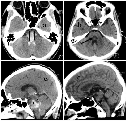 Figure 3: CT images from Case 2 demonstrate incomplete ventral pons involvement: Figure 3a, 3c: Initial CT showing some of anterior pons structure (double vertical arrow) indicating main motor tract are survived. Figure 3b, 3d: Follow-up CT at 4 weeks showing some central hypodensity in the pons consistent with necrotic change. Clinical correlation: patient are good consciousness with variable motor deficit.