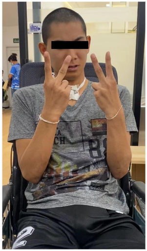 Figure 4: Patient with massive ventral PPH with spared some anterior pons as shown in case number 2 can simple command, and able to walk with assistant.