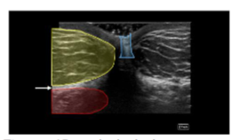 Figure 1B: Labeled short axis to the rectus abdominis ultrasound view of the abdomen. The umbilicus (blue), adipose layer (yellow), the medial aspect of the rectus abdominis (red), and the fascial layer (white arrow) can be identified. This identification is done prior to the introduction of the cannula. The visualization allows the clinician to determine how deep the aspiration can be safely conducted.