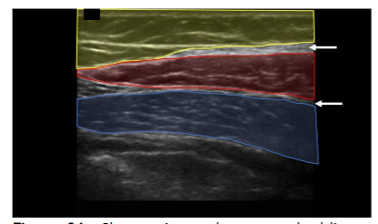 Figure 2A: Short axis to the external oblique muscle ultrasound view of the entry point location. The adipose (yellow), the external oblique (red), the internal oblique (blue), and the fascial layers (white arrows) can be seen. The bowel is below the internal oblique muscle. The beginning of the transition from the thicker adipose region to the thinner adipose region can be seen. The external oblique muscle and the transition between the adipose regions serve as the landmarks for determining the entry point.