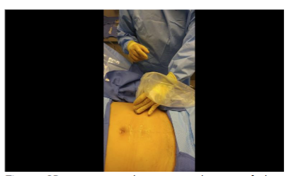 Figure 2B: Corresponding external view of the clinician using the ultrasound transducer to identify the tissues.