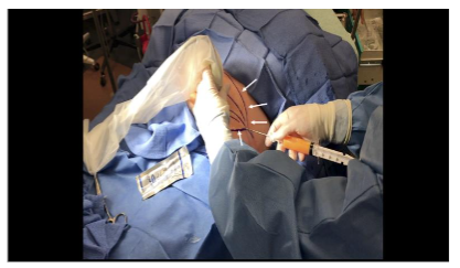 Figure 3B: Corresponding external view of the ultrasound-guided lipoaspiration. The trajectory markings (white arrows), used as a guide during the aspiration, can be seen.