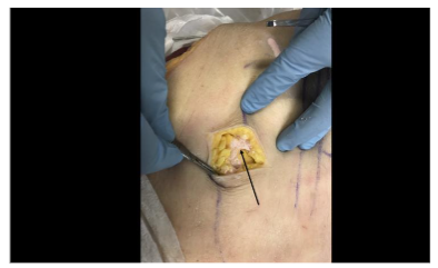 Figure 4: External view of the dissection of a cadaveric specimen following an ultrasound-guided injection of colored latex. The colored latex (black arrow) can be seen in the adipose layer.