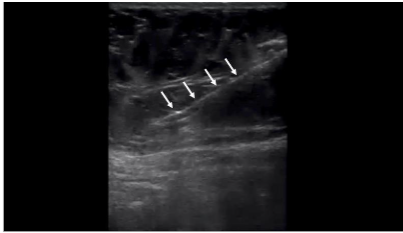 Figure 3A: Short axis to the rectus abdominis muscle, in-plane ultrasound view of the ultrasound-guided lipoaspiration. The cannula (white arrows) can be seen in the adipose layer.