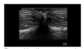 Figure 1A: Short axis to the rectus abdominis ultrasound view of the abdomen.